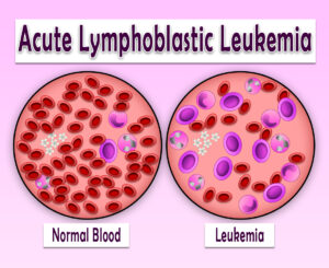 Leukemia: types, symptoms, chemotherapy